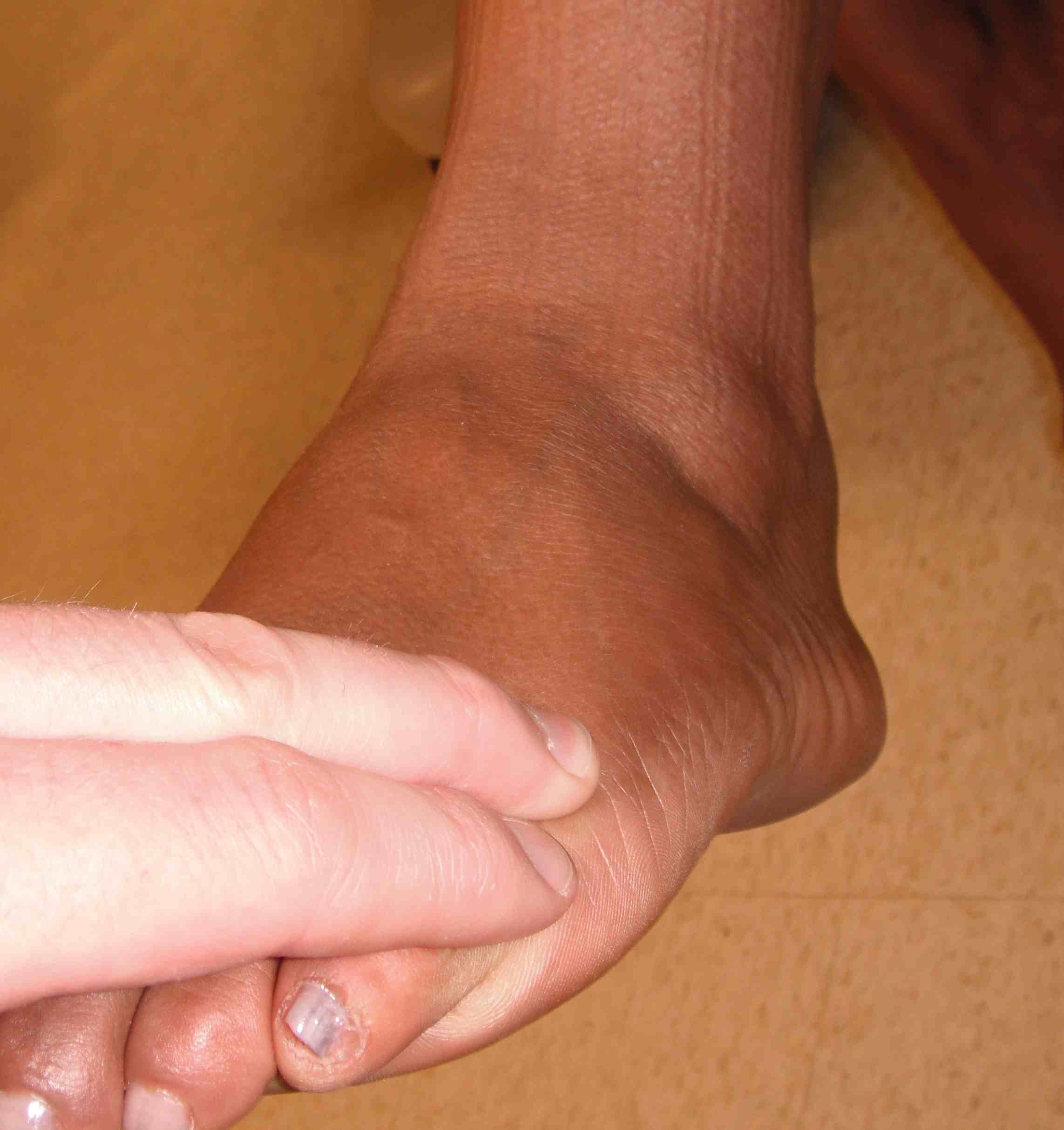 Foot Exam Peroneals